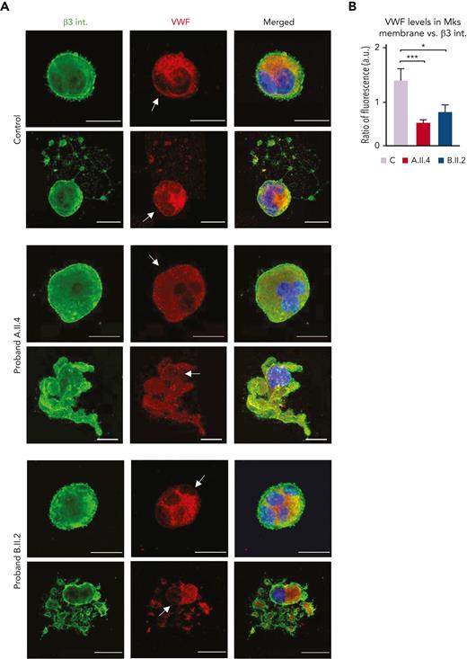 Carriers of GALE p.Lys78ValfsX32, p.Thr150Met, p.Val128Met, and p.Leu223Pro variant displayed VWF delocalization within the MK membrane. MKs were differentiated from peripheral blood progenitor cells (probands A.II.4 and B.II.2) through a 14-days culture, in parallel with healthy controls. (A) Representative image of alpha-granules in mature-polyploid MKs and MK forming proplatelets in control, A.II.4, and B.II.2. Cells were stained with an anti-β3 integrin antibody (green). Alpha-granules were stained with anti-VWF (red). Hoechst (blue) was used for counterstaining nuclei. Arrows indicate the presence of VWF in the control MK membrane, whereas both A.II.4 and B.II.2 had a severely reduced expression of VWF in the membrane. (B) Fluorescence intensity distribution of VWF, relativized with β3 integrin (ratio VWF-β3 integrin), in the MK membrane from healthy controls, A.II.4, and B.II.2. Scale bars, 20 μm. ∗∗∗P < .001; ∗P < .05; 2-tailed Student t test.