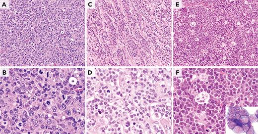 Morphologic characterization of highly proliferative B-cell lymphomas. (A-B) This DLBCL, NOS has many mitotic figures, but many of the neoplastic cells are typical large transformed cells that do not resemble either BL cells or B lymphoblasts. Chromosomal analysis showed a complex karyotype, but there was no evidence of MYC or BCL2 rearrangement. (C-D) This HGBCL, NOS is composed of relatively small blastoid-appearing cells with many mitotic figures, reminiscent of a B-lymphoblastic leukemia/lymphoma. TdT was negative. It had a complex karyotype that included t(14;18)(q32;q21) and i(17)(q10). (E-F) This HGBCL with MYC and BCL6 rearrangements (without evidence of IGH::BCL2) resembles BL with intermediate-size transformed cells and a starry-sky appearance with scattered tingible body macrophages. The cytospin (inset) demonstrated cytoplasmic vacuoles. Unlike classic BL, it was BCL2 protein positive and had only equivocal CD10 positivity. All panels were stained with H&E except for the inset stained with Wright-Giemsa stain. Original magnification ×400 for panels A, C, and E; original magnification ×1000 for panels B, D, and F and inset.