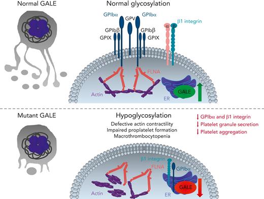 GALE-mediated glycosylation in megakaryocytes and platelets. During late stages of megakaryopoiesis, GALE induces GPIbα and β1 integrin glycosylation in the ER, thereby leading to the trafficking of GPIb-IX-V complex and β1 integrin onto the megakaryocyte surface and subsequently onto newborn platelets. Normal glycosylation supports the interactions between FLNA and GPIbα in the plasma membrane and connects the actin cytoskeleton to the GPIbα complex. In contrast, decreased protein levels and/or reduced enzymatic activity of GALE leads to GPIbα and β1 integrin hypoglycosylation, retaining them in the ER and reducing their externalization on the cell surface. Impaired GALE function also leads to the disorganized and nonuniform actin cytoskeleton and delocalization of FLNA and actin from the plasma membrane to the cytoplasm, forming actin patches, thereby reducing actin contractility. These pathologic processes strongly impair platelet production, size, and function. Therefore, GALE mutant-patients develop macrothrombocytopenia, characterized by giant/gray and apoptotic platelets with strongly reduced membrane localization of GPIb-IX-V complex and β1 integrin, defective granule secretion, and platelet aggregation. GP, glycoprotein; FLNA, filamin A.