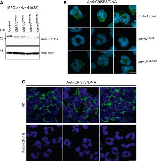 Expression and localization of CRISP3 in iPSC-derived neutrophil-like granulocytes and in primary cells. (A) Immunoblot analysis of lysates from iPSC-derived control and SRP-mutated iPSCs harvested at differentiation day 26. Cells were harvested at day 26, lysed, and processed for immunoblotting with the indicated antibodies. (B) Confocal images of iPSC-derived control and SRP-mutated cells stained for CRISP3. Cells were immunostained on differentiation day 26 with an anti-CRISP3 antibody and DNA was visualized with DAPI. Scale bar, 10 μm. (C) Confocal images of immunostaining of CRISP3 in a healthy donor and in a patient with the identified SRP19 gene variant. DNA was visualized with DAPI. Scale bar, 10 μm. The experiment in panels A and B was performed in triplicate, whereas the experiment in panel C twice.
