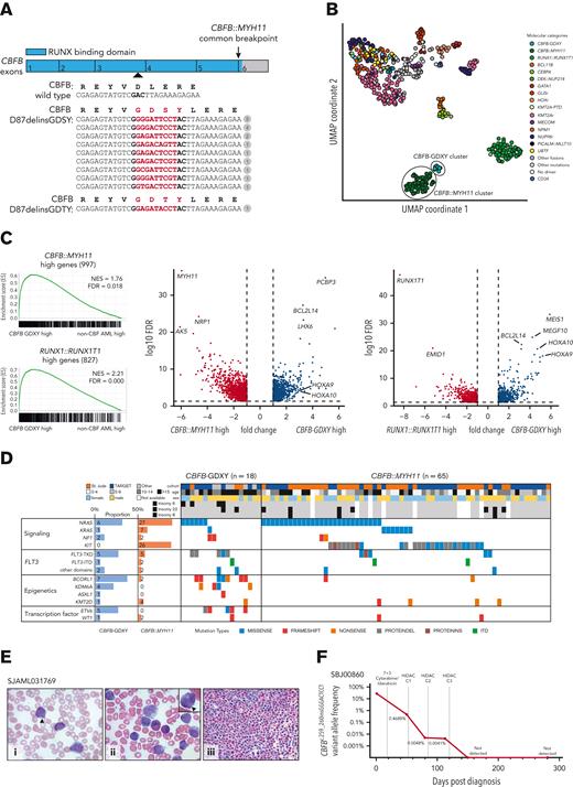A novel subtype of AML characterized by CBFB-GDXY mutations. (A) Graphical representation of CBFB exons 1 to 6 (NM_022845.3) showing the location (arrowhead) and sequence of the 9 bp insertion mutations (highlighted in red) relative to the wild-type complementary DNA sequence. The number of patients with each mutation is shown in the circles. The predicted protein sequence of the CBFB mutations is also shown in red. (B) Uniform manifold approximation and projection (UMAP) of expression profiles of the pediatric AML cohort (AML, n = 561; cord blood CD34+ control, n = 5) performed with the top 133 most variably expressed genes. Dots are colored by the molecular feature of the sample. (C) Gene set enrichment analysis (GSEA) between AML with CBFB insertions and non-CBF AML (left) using gene sets derived from differentially expressed genes in CBFB::MYH11 AML or RUNX1::RUNX1T1 AML against non-CBF AML. Volcano plots (right) of genes differentially expressed between AML with CBFB insertions and CBFB::MYH11 or RUNX1::RUNX1T1. (D) Mutational landscape of CBFB-GDXY AML (n = 18) in this study (mutations detected at diagnosis are shown) and CBFB::MYH11 AML (n = 65) collected in the previous study.3 Seventy-five preselected genes frequently mutated in AML were subjected to mutation calling from RNA sequencing data. Eight FLT3 mutations were detected in seven patients and are categorized as internal tandem duplications (ITD), mutations in the tyrosine kinase domain (TKD), or mutations outside the TKD (other domains). (E) (i) Giemsa-stained peripheral blood showed blasts with myeloid and monoblastic features; arrowhead marks single slender Auer rod (original magnification ×1000). (ii) Giemsa-stained bone marrow aspirate smears showed immature myeloid elements with granules, blasts, and eosinophils (original magnification ×1000); arrowhead marks salmon-colored granules in the cytoplasm of the myeloid cell (inset). (iii) Hematoxylin and eosin–stained bone marrow biopsy (original magnification ×500) showed a hypercellular marrow almost completely replaced by a diffuse infiltrate of medium-sized blasts with increased eosinophils in the background. (F) Measurable residual disease assessment of the CBFB c.259_260insGGGACTCCT mutation by ultradeep next-generation sequencing in SBJ00860.