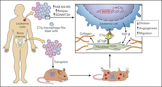 New findings in AML with extramedullary infiltration. Macrophage-like C1q blast cells were more frequent in extramedullary AML lesions, and these blasts cell were more prone to disseminate in a xenotransplantation experiment. Cytokine-mediated and direct interactions with tissue fibroblasts were implicated in chemotherapy resistance. Professional illustration by Patrick Lane, ScEYEnce Studios.