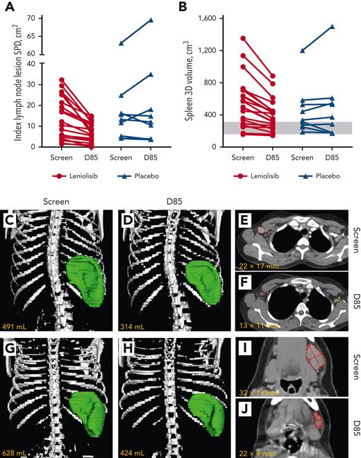 Changes in lymphoproliferation parameters. (A) Individual untransformed SPD of index lymph nodes (leniolisib, n = 19; placebo, n = 9). Reference range (≤1.5 × 1.5 cm) not shown as up to 6 lymph nodes may be counted per patient.26 (B) Individual spleen volumes (leniolisib, n = 20; placebo, n = 9). The gray box indicates the reference range for adults.28 All patients from the safety analysis set with measurements are included in (A) and (B), whereas efficacy analyses used the PD analysis set. (C-J) Radiographic renderings of spleen volume (C, D, G, H) and lymph node diameters (E, F, I, J) at screening and D85 from 2 patients in the leniolisib arm. The images in the top row (C-F) are from a 29-year-old female. The investigator diagnosed splenomegaly at screen (C) that was deemed absent by D85 (D). The index axillary lymph node lesion outlined in red decreased in size over the trial (E-F). Yellow and purple outlines in (F) indicate non-index lymph nodes. The images in the bottom row (G-J) are from a 17-year-old male. The investigator diagnosed splenomegaly at screen (G) that remained present by D85 despite the spleen decreasing in size (H). The index upper cervical lymph node lesion outlined in red (I-J) decreased in size over the trial.