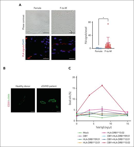 Dermal vascular endothelial cells are important targets for cGVHD by expressing DBY/HLA class II complexes. (A) PLAs to visualize protein–protein interactions between DBY and HLA-DR in cGVHD. Colocalization of DBY and HLA-DR induced PLA signals (red). Nuclei were stained with DAPI (blue). Bar plots indicate the PLA signals per vessel from the skin of female patients with cGVHD (n = 9) and patients with cGVHD with F-to-M HCT (n = 12). Data are presented as the mean ± SD. P values were calculated using unpaired 2-tailed Student t test. ∗P < .05. PLA signals of patients who underwent F-to-M HCT vs female patients. (B) Representative immunofluorescence images of CD31 (red) as an endothelial marker and α-smooth muscle actin (αSMA; green) as a myofibroblast marker in skin biopsy samples from healthy donors (n = 2) and patients with cGVHD (n = 7). (C) Analysis of CDC using anti-DBY/HLA class II complex antibodies. Purified total IgG from cGVHD plasma, including anti-DBY/HLA class II complex antibodies, were mixed with 293T cells transfected with mock (light green line), DBY (purple line), HLA-DRB1∗09:01 (dark green line), HLA-DRB1∗12:01 (orange line), HLA-DRB1∗15:02 (pink line), DBY and HLA-DRB1∗09:01 (light blue line), DBY and HLA-DRB1∗12:01 (dark blue line), or DBY and HLA-DRB1∗15:02 (red line) followed by incubation with complement. Dead cells were assessed using flow cytometry. Data are presented as the mean ± SD of 3 independent experiments. Mock: pSI vector. Scale bars: 20 μm (A) and 50 μm (B). Original magnification, ×400 (A) and ×200 (B). DAPI, 4',6-diamidino-2-phenylindole.