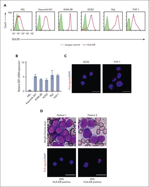 DBY colocalized with HLA class II molecules in male leukemic cells. (A) Flow cytometry of HLA-DR expression of leukemic cell lines (HEL, KasumiA-541, KHM-2B, KO52, Raji, and THP-1 cells). Cells were stained with isotype control (shaded histogram) and anti-HLA-DR (red line) antibodies. (B) Quantitative real-time polymerase chain reaction analysis of the expression of DBY messenger RNA (mRNA) levels in the leukemic cell lines. Bar plots indicate DBY mRNA expression relative to control glyceraldehyde-3-phosphate dehydrogenase (GAPDH) mRNA expression. DBY mRNA levels are presented as the mean ± SD of 3 independent experiments. (C) PLAs to visualize colocalization between DBY and HLA-DR in leukemic cell lines. Colocalization of DBY and HLA-DR induced PLA signals (red). Leukemic cell lines of KO52 (left) and THP-1 (right). (D) Cryopreserved isolated mononuclear cells from bone marrow (BM) in patients with leukemia at diagnosis were used for PLAs. Patients 1 and 2 were diagnosed with HLA-DR–positive acute myeloid leukemia (AML). Wright-Giemsa stain (upper 2 microphotographs) and PLAs (lower 2 fluorescence microphotographs). Nuclei were stained with DAPI. Scale bars: 20 μm (C-D). Original magnification, ×400 (C-D). All data are representative of 3 independent experiments. DAPI, 4',6-diamidino-2-phenylindole.