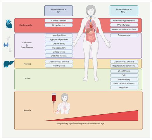 Complications of NTDT compared with those of TDT. The prevalence of clinical morbidities in TDT and NTDT is based on observational studies. The figure illustrates those complications that are observed at a higher prevalence in NTDT or TDT, although all mentioned complications can manifest in both entities. The prominence of uncontrolled ineffective erythropoiesis in the absence of transfusion therapy mediates a distinctive constellation of complications related to chronic anemia, hypercoagulability, and iron overload in NTDT. EMH, extramedullary hematopoiesis; LV, left ventricular; RV, right ventricular. Figure created with BioRender.
