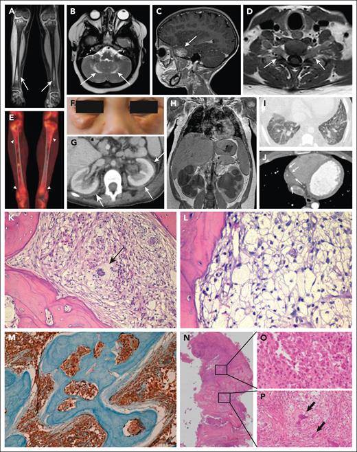 Typical ECD manifestations and bone pathology in patients with ECD and mixed ECD-LCH. (A) Coronal magnetic resonance imaging (MRI) scan showing bilateral symmetric osteosclerosis of tibial meta-diaphysis (arrows). (B) Axial MRI scan of the brain showing bilateral hyperintense lesions of the dentate nuclei (arrows). (C) Sagittal MRI scan of the brain depicting a skull base meningioma-like lesion of the greater sphenoid wing (arrow). (D) Axial MRI scan of the cervical spine showing a bilateral lesion with slight enhancement forming a dumbbell-shaped mass inside the neural foramina at C5-C6 level (arrows). (E) 18F-fluorodeoxyglucose positron emission tomography showing high metabolic activity of tibial metadiaphyseal lesions (arrowheads). (F) Periorbital xanthelasma-like lesions. (G) Axial abdominal computed tomography (CT) scan showing bilateral perinephric infiltrates (“hairy kidneys”) (arrows). (H) Coronal abdominal CT scan showing massive bilateral hydroureteronephrosis in a patient with perinephric ECD infiltrates. (I) High-resolution axial CT scan of the chest demonstrating bilateral interlobular septal thickening and ground-glass opacities. (J) Axial CT scan of the chest showing cardiac pseudotumor (arrows) developed around the right coronary artery and into the right atrioventricular sulcus. (K) Bone biopsy showing an infiltrate comprising numerous foamy histiocytes and a multinucleated Touton cell (arrow) associated with fibrosis. (L) Diffuse infiltration by foamy histiocytes. (M) Classic ECD CD68 immunostaining in a bone biopsy. (N) Mixed lesion showing an area occupied by numerous Langerhans cells with ovoid to reniform nuclei, consistent with LCH (O) and a concomitant area showing numerous foamy histiocytes and multinucleated Touton cells (arrows), consistent with ECD (P). K-L and N-P: Hematoxylin and eosin staining; M: immunohistochemical staining for CD68-PGM1. Original magnification: K, ×20; L, ×40; M, ×10; N, ×2; O-P, ×40.
