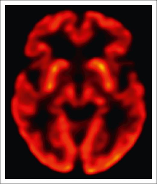 Normal uptake in the basal ganglia on brain FDG-PET in a BCMA-CAR T-cell patient with reversible parkinsonism. See Figure 1G in the article by Graham et al that begins on page 1248.
