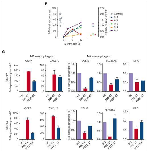 Platelet, monocyte, dendritic cell, and macrophage (myeloid) reconstitution. (A) Evolution of platelet levels after GT (left axis) and comparison to VCN in positive CFUs (left axis). (B) Comparison of mean platelet volume before and after GT (latest F/U). Statistics: Wilcoxon signed-rank test. (C) Comparison of platelet counts (≥18 months after GT) in relation to the number of transduced CD34+ cells infused on day 0. (D) Monocyte (CD14+) WASp expression (percentage WASp+ cells) by flow cytometry (latest F/U). (E) Evaluation of podosome formation by actin and vinculin colocalization by confocal imaging in stimulated CD14+ cells. (F) Evaluation of cytoskeletal function by determination of the percentage of podosome-forming cells in monocyte-derived dendritic cells (left axis) in comparison to the neutrophil VCN at 12 months (right axis). (G) Evaluation of messenger RNA expression of M1 and M2 markers by quantitative polymerase chain reaction of monocyte–derived macrophages before and after GT in patient 2 (9 months after GT) and patient 4 (3 months after GT). Graphs represent mean ± standard deviation of duplicates analyzed for each graph bar. MPV, mean platelet volume.