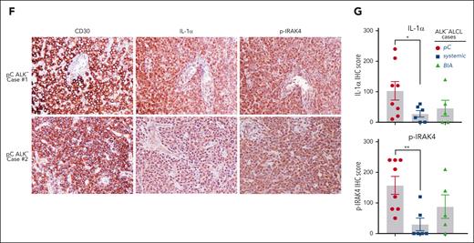 IL-1α production in ALK− ALCL cell lines and primary cases. (A) Relative IL-1α and IL-1β mRNA expressions, measured by real-time polymerase chain reaction (PCR) and normalized to glyceraldehyde-3-phosphate dehydrogenase (GAPDH) values, in indicated lymphoma cell lines. Error bars denote standard error of the mean (SEM) of triplicates. (B) IL-1α production, measured by in-cell ELISA (cell lysate) and normalized to cell numbers, in indicated lymphoma cell lines. Error bars denote SEM of triplicates. (C) MAC1 and MAC2A lines were transduced with IL-1α or ctrl sgRNAs, selected, and expression induced. IL-1α production was measured by in-cell ELISA as in panel B. P was calculated comparing the ctrl sgRNA (sgCTRL) and sgIL-1α groups; ∗∗P < .01. Error bars denote SEM of triplicates. (D) Immunofluorescence confocal microscopy analysis of the distribution of endogenous IL1R1 and IL-1α in the indicated lines. Antibodies used are indicated on the top. (E) Indicated ALCL lines were transduced with Ctrl or IL-1α sgRNAs and selected. Relative proliferations upon sgRNA induction were measured by the Promega CellTiter Cell Proliferation Assay (MTS) and normalized to the Ctrl sgRNA groups. P was calculated comparing sgCTRL and sgIL-1α groups; ∗P < .05; ∗∗P < .01. Error bars denote SEM of triplicates. (F) Immunohistochemistry (IHC) of IL-1α, p-IRAK4, and CD30 expression of 2 pC ALK− ALCL cases. Sections were examined microscopically using 100× original magnification. The depicted images are representative of the 19 ALK− ALCL cases examined. (G) IL-1α and p-IRAK4 IHC scores (detailed at supplemental Table 2) in 3 subgroups of primary ALK− ALCL cases. ∗P < .05; ∗∗P < .01.