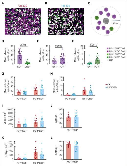 High densities of PD-1+ T cells proximal to HRS cancer cells. mIF imaging was performed to quantify tumor-infiltrating T cells. Cells were phenotyped as PD-1− CD4+ T cells, PD-1+ CD4+ T cells, PD-1− CD8+ T cells, PD-1+ CD8+ T cells, or HRS cells. Representative images (scale bar, 50 μm) with displayed phenotypes are shown for a patient with CR (A) and a patient with PR (B). Cell counts within 50 μm of a HRS cell were quantified (C). Mean counts of total CD4+ and CD8+ T cells (D), PD-1− and PD-1+ CD4+ T cells (E), and PD-1− and PD-1+ CD8+ T cells (F) for each tissue assessed are shown. Mean counts within 50 μm of an HRS cell of PD-1+/− CD4+ T cells (G) and PD-1+/− CD8+ T cells (H) were also compared between patients with CR or PR/SD/PD. Similarly, CD4+ densities (I), percentage of CD4+ T cells expressing PD-1 (J), CD8+ densities (K), and percentage of CD8+ T cells expressing PD-1 (L) in patients with CR compared with those with PR/SD/PD. Statistics are generated using unpaired Student t tests.