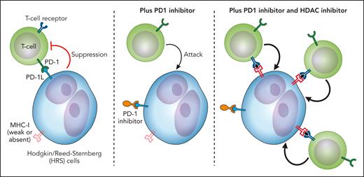 A model showing how the addition of an HDAC inhibitor may enhance the activity of a PD1i in cHL through increased immune receptor expression (such as MHC class I), increased recruitment, and activation of T cells. Professional illustration by Patrick Lane, ScEYEnce Studios.