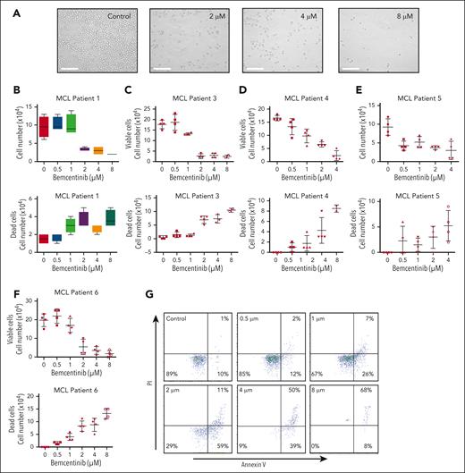 Bemcentinib induces apoptosis of MCL primary cells. (A) Patient–derived MCL cells were treated with dimethyl sulfoxide (DMSO) or various concentrations of bemcentinib (0-8 μM) for 24 hours. Relevant microscopy pictures revealed the presence of apoptotic cells and a reduction of the cell populations. Scale bar, 100 μM. (B-F) Cell proliferation and cell death were measured by cell counting and trypan blue staining. Experiments were performed 4 times and the mean and distribution are shown. (G) Cell death was also investigated by flow cytometry using annexin V/PI staining in patient–derived MCL cells. Bemcentinib induced apoptosis in primary MCL cells in vitro.