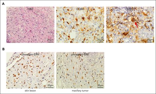 H syndrome tissue biopsies contain RDD–like infiltrating histiocytes positive for phospho-ERK. (A) FFPE sections of skin lesion (patient H1, supplemental Table 1). Left: H&E staining demonstrates diffuse infiltration of the dermis by histiocytes with a large pale cytoplasm, accompanied by scattered lymphocytes and plasma cells. Middle and right: infiltrating histiocytes are positive for CD68 and S100. Emperipolesis is marked by an arrow. (B) The infiltrating histiocytes in skin lesion (left panel) and maxillary sinus tumor (right panel) of patient H1 show strong positivity for phospho-ERK. H&E, hematoxylin and eosin.