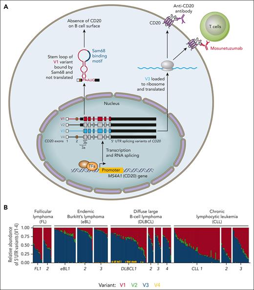 The 5'-UTR splicing variants of MS4A1 (encoding CD20) and their frequency in mature B-cell malignancies. (A) The transcription of MS4A1 is regulated by multiple cell signals and transcription factors (TFs). Four 5'-UTR isoforms (V1-V4) of MS4A1 have been identified resulting from distinct splicing events between exon 1 and 3 (internal splice site), but all have identical coding sequences (translation start codon is localized within exon 3). The V3 and V4 represent translation proficient variants, whereas inefficient translation of V1 and V2 transcripts is rate-limiting for CD20 protein production. The V1 and V2 variants harbor multiple upstream open reading frames and a stem-loop secondary structure containing binding sites for Sam68 protein. (B) The frequency of V1-4 variants of MS4A1 in samples from multiple cohorts of B-cell malignancies (FL, n = 2; endemic BL, n = 3; DLBCL, n = 4; CLL, n = 3). The V1 and V3 represent together >90% of MS4A1 isoforms, and their ratio has a wide distribution within samples from the same diagnosis. Professional illustration by Patrick Lane, ScEYEnce Studios.