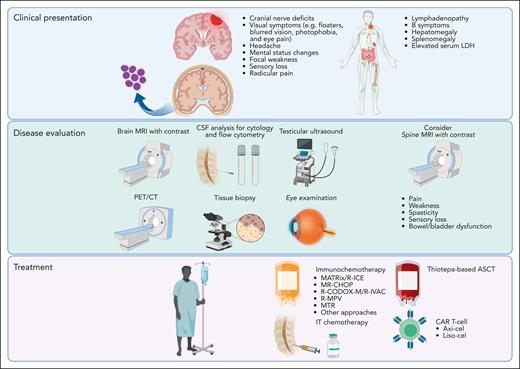 Diagnostic evaluation and treatment approach for patients with secondary CNS lymphoma. Secondary CNS involvement in aggressive lymphomas can be leptomeningeal or parenchymal, with symptoms related to disease location. Initial assessment includes neuroimaging and PET/CT associated with CSF evaluation (cytology and flow cytometry) and appropriate tissue biopsies. Testicular ultrasound is also required to complete the assessment for male patients. Treatment options comprise systemic immunochemotherapy with agents capable to cross the BBB and IT chemotherapy associated with ASCT, anti-CD19 CAR T-cell therapy, or BTKis, when appropriate.