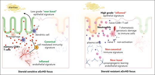 Proposed schema of pathophysiology in aGVHD of colon in the context of steroid response. A typical SS focus would have immune cells related to classic CMI response, amenable to steroid (S) therapy. The epithelium would be leaky with overactive ion channels, having experienced LG damage with mainly apoptosis and the occasional crypt loss. The endothelium would show an inflammatory signature. Contrarily, an SR focus would have a neutrophil-rich immune milieu with stunted CMI response, possibly secondary to genotoxic damage to host-derived antigen-presenting cells. There would be HG pathology in colonic epithelium with extensive crypt loss, and the vessels would exhibit a near basal functioning phenotype with some neoangiogenic signatures.