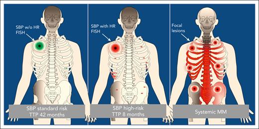 Dissemination of clonal plasma cells in solitary bone plasmacytoma and MM. In MM, focal lesions are usually superimposed on diffuse infiltration patterns, whereas in SBP the potential for invasion and dissemination at distant bone marrow sites and, as a consequence, the time to progression (TTP) are associated with high-risk (HR) cytogenetics.
