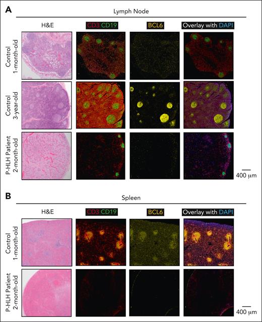 Germinal centers and BCL6-expressing Tfh and B cells are decreased in the lymph node and spleen of a patient with P-HLH. Panel showing multiplex immunofluorescence (CD3, red; CD19, green; BCL6, yellow; and DAPI, blue) images from (A) lymph node and (B) spleen of controls (a 1-month-old infant and a 3-year-old) and a patient with active P-HLH (aged 2 months). Primary follicles present in lymph nodes of both controls. Germinal centers not prominent in lymph node of younger control but present in older control. Lymph nodes of the patient with HLH lack primary follicles and germinal centers. The spleen of the control demonstrates areas of distinct white pulp, whereas the spleen of the patient with HLH lacks white pulp.