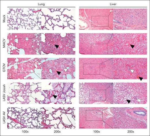 Histopathological changes associated with hemostasis defects in the organs of infected monkeys. Samples harvested during necropsy of animals infected with MACV, GTOV, LASV Josiah, LASV AV, or mock-infected were stained using hematoxylin-eosin coloration. Black squares correspond to the area imaged in the inset on the right. Left column: lungs show varying degrees of hemorrhage, alveolar edema, and interstitial infiltration. Black arrowheads indicate areas of hemorrhage and white arrowheads indicate alveolar edema. Right column: hepatic parenchyma injury includes macrovesicular steatosis, focal necrosis and peri-portal mononuclear infiltrates. Black arrowheads indicate areas of hepatocellular degeneration and necrosis; white arrowheads indicate inflammatory infiltrates. Images are representative of observations made in 3 different animals for each condition. Left column scale bar = 100 μm; right column scale bar = 50 μm.