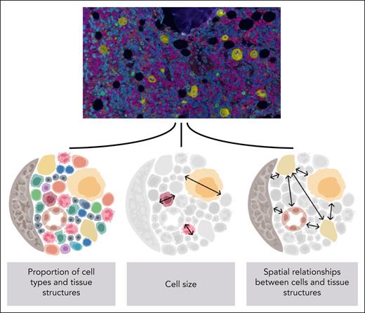 Overview of the end-to-end pipeline used in the study. Images (20× objective magnification) of fluorescent immunohistochemistry-stained bone biopsy samples (DAPI, blue; CD34, purple; CD38, orange; CD117, green; CD61, yellow) were analyzed with multiple deep learning-based algorithms to explore the spatial dimension of human hematopoiesis. See Figures 1B and 2C in the article by Sarachakov et al that begins on page 2282.