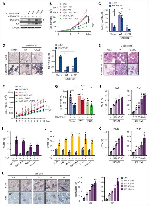 ZDHHC21-induced AML proliferation, stemness, and differentiation blockage depends on its palmitoyl acyltransferase activity. (A) The protein levels of mZDHHC21 in shZDHHC21-transfected HL60 cells re-expressing mZDHHC21-HA or mZDHHC21(C120S)-HA. (B) Cell proliferation of shZDHHC21-transfected AML cells re-expressing mZDHHC21-HA or mZDHHC21(C120S)-HA in HL60 cells. (C) The colony-forming ability of HL60 cells after culturing in soft agar. (D-E) Differentiation analysis of shZDHHC21-transfected HL60 cells re-expressing mZDHHC21-HA or mZDHHC21-C120S-HA. (D) NBT-reducing activity. (E) Cell morphological analysis after Wright-Giemsa staining. (F-G) mZDHHC21 overexpression but not mZDHHC21 (C120S) rescued shZDHHC21-induced tumor growth arrest in the subcutaneous xenograft model. NB4 cells infected with vector, mZDHHC21, or mZDHHC21 (C120S) were injected subcutaneously into 4- to 5-week-old female NSG mice and then received an intratumoral injection of virus containing shCtrl or shZDHHC21. (F) Tumor growth of NB4 xenografts. Tumor volume growth curves are presented as the mean ± SE, n = 5. The red arrow indicates the time of intratumoral injection. (G) Tumor weight of each group. (H-I) Cell differentiation analysis of AML cells treated with 2BP for 3 days. (H) CD11b expression of HL60 cells and NB4 cells treated with 2BP at a series of concentrations (0, 10, 20, 40, 60 μM). (I) CD11b expression of other AML cell lines treated with 2BP at a single concentration. MV411 (40 μM), OCI-AML3 (60 μM), THP-1 (60 μM), and Kasumi-1 (60 μM). (J) CD11b expression of AML cells treated with TM by a single concentration. HL60 (1 μg/mL), NB4 (0.03125 μg/mL), MV411 (0.25 μg/mL), OCI-AML3 (1 μg/mL), THP-1 (0.125 μg/mL), and Kasumi-1 (0.0625 μg/mL). (K) CD14 expression of HL60 and NB4 cells treated with 2BP at a series of concentrations (0, 10, 20, 40, 60 μM). (L) NBT-reducing activity of HL60 cells and NB4 cells treated with 2BP at a series of concentrations (0, 10, 20, 40, 60 μM). Data are shown as mean ± SD, n = 3. n.s., P > .05; ∗P < .05; ∗∗P < .01; ∗∗∗P < .001. The significance analysis was conducted by a two-tailed unpaired t test or a one-way analysis of variance. WT, wild-type.