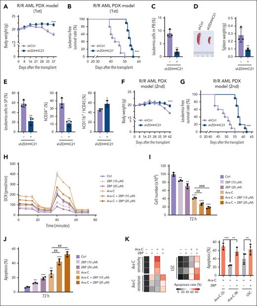 Targeting ZDHHC21 is a potential therapeutic strategy for relapsed/refractory AML. (A-G) The in vivo effect of ZDHHC21 depletion on leukemogenesis in R/R PDX-AML xenograft model subjected to primary and secondary transplant. NSG mice underwent transplantation with shCtrl or shZDHHC21-transfected AML blasts. (A) Body weight of NSG mice. (B) The survival time of NSG mice. Data are presented as mean ± SD (n = 10). ∗∗∗P < .001 vs shCtrl. The significance analysis was conducted by log-rank test. (C) The population of hCD45+mCD45− leukemia cells in the peripheral blood of NSG mice. (D) Spleen weight of NSG mice on 39 days after transplantation (mean ±SD; n = 3). (E) The population of hCD45+mCD45− leukemia cells and CD34+ and CD11b+ cells in the spleen (SP) of NSG mice (mean± SD; n = 3). (F) The body weight of secondary transplant mice. (G) Kaplan-Meier survival curves of secondary transplant mice upon ZDHHC21 knockdown (n = 10). ∗∗∗P < .001 vs shCtrl. The significance analysis was conducted by log-rank test. (H) Mitochondrial OCR of HL60 cells after treatment with control, 2BP, Ara-C, or Ara-C + 2BP for 24 hours. OCR was assessed using a Seahorse analyzer. (I) The effect of 2BP, Ara-C, or Ara-C + 2BP on the proliferation of HL60 cells. HL60 cells were treated with drugs for 72 hours, followed by trypan blue exclusion test. (J) The effect of 2BP, Ara-C, or Ara-C + 2BP on the apoptosis of HL60 cells for 72 hours. The apoptosis was confirmed by PI/annexin V assay. Data are presented as mean ± SD (n = 3). n.s., P > .05; ∗P < .05; ∗∗P < .01; ∗∗∗P < .001 vs Ctrl. #P <.05; ##P < .01; ###P < .001 vs Ara-C. (K) The effect of Ara-C or Ara-C + 2BP on the apoptosis of primary AML blast cells and LSCs. Primary AML blast cells were directly separated from the bone marrow of patients using lymphocyte monocytes separation medium. LSCs were sorted by CD34 marker from AML specimens. The apoptosis rate of cells was detected after treatment with drug for 3 days. ∗∗P < .01; ∗∗∗P < .001. The significance analysis was conducted by a two-tailed unpaired t test or a one-way analysis of variance.