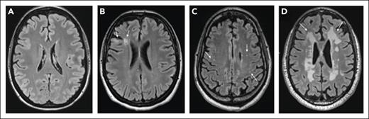 Brain MRI findings in patients with iTTP (representative images). Normal MRI without ischemic findings (A), small FLAIR hyperintense foci (>3-5 mm in length, arrows) in the cortical/subcortical region and deep white matter (B), punctate FLAIR hyperintense lesions (arrows) in the white matter (C), and confluent FLAIR hyperintensity (arrows) in the periventricular and deep white matter (in a patient without overt neurologic findings) (D).