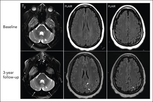 Brain MRI findings of incident SCI since prior stroke. At baseline (top), small chronic infarcts in the cerebellar hemispheres are well depicted on T2 weighted sequences (arrows) of a MRI done in routine clinical care for dizziness persisting 3 weeks after achieving clinical remission after a first iTTP episode, which were unchanged on the follow-up research scan. At 3-year follow-up, upon the research MRI (bottom), there are multifocal new small chronic infarcts in the left parietal cortical regions seen on axial FLAIR images (arrowheads).