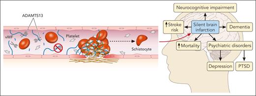 Thrombotic microangiopathy and the brain. In iTTP, autoantibodies against ADAMTS13 (a disintegrin and metalloproteinase with a thrombospondin type 1 motif, member 13) prevent the cleavage of VWF multimers, leading to microthrombus formation and endothelial damage and resulting in ischemic end-organ damage, particularly in the central nervous system. SCIs are common in patients with iTTP while in remission and carry significant risks of associated morbidity and mortality. PTSD, posttraumatic stress disorder. Professional illustration by Patrick Lane, ScEYEnce Studios.