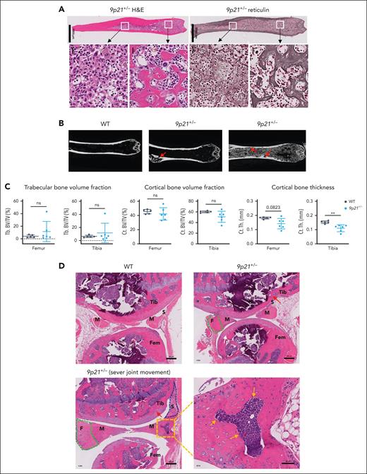 The disorders of the BM environment in 9p21s+/− MDS/MPN–like mice. (A) Hematoxylin and eosin and reticulin staining of serial femur bone sections from a representative 9p21+/− MDS/MPN mouse. (B) Micro-CT images of the femurs in 9p21+/− tumor and WT mice. Red arrows show the abnormal cortical bone in 9p21+/− tumor mice. (C) Quantification of trabecular bones and cortical bones volume in femur and tibia total bone volume. Symbols represent individual mice (WT mice, n = 5; 9p21+/− tumor mice, n = 6). Data represent the mean ± SD. Statistical significance was defined using Mann-Whitney test and is shown as follows: ∗∗P < .01. (D) Hematoxylin and eosin staining of knee joints from 9p21+/− tumor and WT mice. Green dotted lines indicate increased fibrous regions in meniscus; gold arrows indicate bone formation in meniscus; a blue dotted line indicates thicker synovium; red arrows indicate osteophyte in cartilage. Ct. BV/TV, cortical bone volume fraction; Ct.Th, cortical bone thickness; F, fibrous region; Fem, femur; M, meniscus; S, synovium; Tb. BV/TV, trabecular bone volume fraction; Tib, tibia.