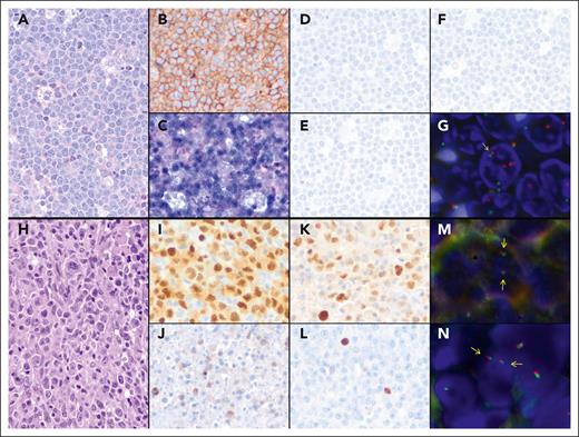 Morphological, immunohistochemical, and genetic features of 2 prototypical post-SOT mPTLD, BL (case p11), and DLBCL cases (case p10), respectively. Case p11: (A) hematoxylin and eosin, original magnification at ×400. (B) Tumor cells are diffusely positive for CD10 (immunostain, original magnification at ×400). (C) In situ hybridization for EBV RNA is positive in tumor cells (in situ hybridization, original magnification at ×400). (D-F) Neoplastic cells are negative for LMP1 (D), EBNA2 (E), and ZEBRA (F) immunostains, indicating latency pattern I (immunostains, original magnification at ×400). (G) FISH using MYC Break-Apart Probe (BAP) shows a signal constellation of 1 colocalized signal (yellow arrow) and 2 split signals (green and red arrows) in accordance with the gene rearrangement. Case p10: (H) DLBCL with focal plasmacytic differentiation (hematoxylin and eosin, original magnification at ×400). (I) Atypical cells are diffusely positive for MUM1 (immunostain, original magnification at ×400). (J-L) LMP1 (J), EBNA2 (K), and ZEBRA (L) immunostains show positive tumor cells, reflecting a pattern III of latency (immunostains, original magnification at ×400). (M-N) FISH using BAP for MYC (M) and IRF4 (N) genes show a normal pattern with 2 colocalizations in each nucleus for both hybridizations (yellow arrows).