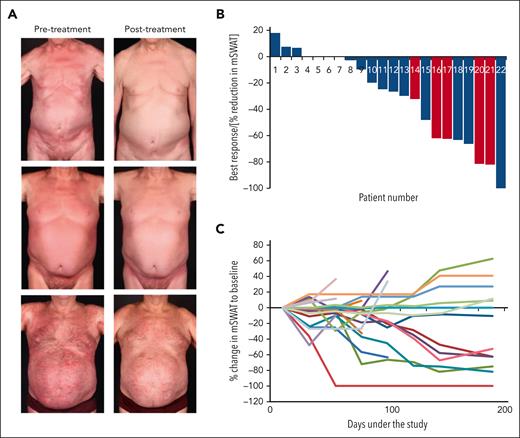 Efficacy of DMF treatment in CTCL. (A) Representative clinical pictures of responding patients at the start and the end of study treatment. (B) Waterfall plot of best response in the skin of the patients in the per-protocol cohort, depicted by a reduction in the mSWAT score. Patients with SS with high tumor load (mSWAT score > 100 and SC count > 1000/μL at study start) are depicted in red. (C) Spider plot of response in the skin for all patients in the per-protocol cohort throughout the study. One patient in the per-protocol cohort who died had no mSWAT values after baseline and therefore could not be evaluated for response.