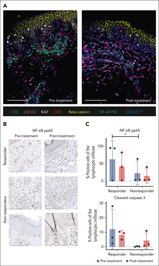 Skin response to DMF correlates with NF-κB, changes in microenvironment and T-cell death. (A) CODEX 7-color overlay images from skin samples of a representative responders before and after DMF study treatment. The paraffin samples were stained for CD8, CD163, CD4, β-catenin, and NF-κB p65, and the DNA dye DRAQ5 was used for nuclear staining. (B) Representative IHC pictures of skin samples from 1 responder and 2 nonresponders stained for NF-κB pp65 before and after study DMF treatment. (C) Statistical analysis of pp65 and cleaved caspase-3 staining in 3 representative responders and 3 nonresponders before and after DMF study therapy. Depicted is the percentage of positive lymphocytes from the complete lymphocytic infiltrate. ∗P < .05.
