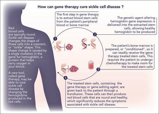 Explanation of the process of ex vivo gene therapy. Modified (with permission) from a figure provided by the Cure Sickle Cell Initiative (https://curesickle.org/genetic-therapies) for patients, caregivers, and the general public.