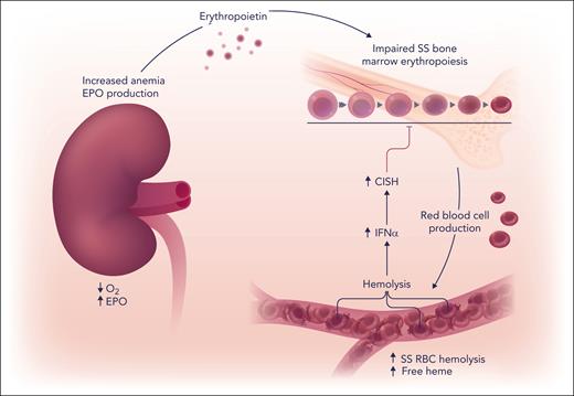 Anemia in sickle cell disease increases hypoxia induction of erythropoietin (EPO) in the kidney to stimulate bone marrow erythropoiesis and red blood cell (RBC) production. In the circulation, polymerization of deoxygenated sickle hemoglobin leads to repeated sickle (SS) erythrocyte sickling and unsickling, increased red blood cell fragility, and oxidative stress that causes intravascular hemolysis. The release of cell-free heme in the circulation promotes a proinflammatory state and increases interferon-α (IFN-α) that increases erythroid expression of suppressor of cytokine signaling family member, CISH. CISH decreases erythropoietin signaling in erythroid cells, resulting in impaired bone marrow erythropoiesis. Professional illustration by Somersault18:24.