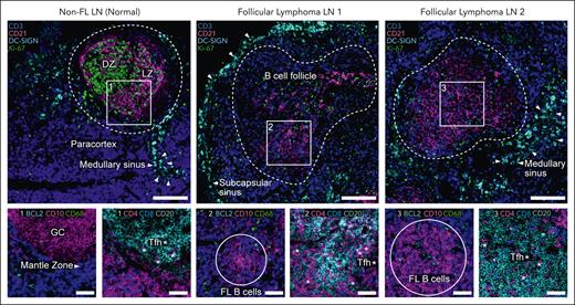 Spatial organization and cellular composition of non-FL and FL LNs from human patients. Cell DIVE41 imaging platform and IBEX42 dye inactivation protocol were combined for high parameter imaging (Cell DIVE-IBEX). Changes in the organization and cellular composition of FL LNs as compared with non-FL (normal) LNs. B-cell follicle outlined by dotted line. Arrows denote medullary or subcapsular sinus enriched with DC-SIGN+ myeloid cells. Scale bar, 150 μm (large images) and 50 μm (small images). LZ and DZ of GC. Example Tfh cells marked by asterisks. IBEX, iterative bleaching extends multiplexity.