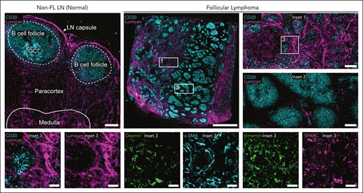 Stromal remodeling and ECM deposition in FL TME. Cell DIVE-IBEX images of tissue sections from excisional LN biopsies. Non-FL LN, scale bar, 150 μm. FL overview, scale bar, 2 mm. (Insets 1-2) Images depict heterogeneity in the amount of ECM (lumican); scale bars, 150 μm. (Insets 3) Stromal diversity using indicated markers; scale bar, 50 μm. α-SMA, α-smooth muscle actin; IBEX, iterative bleaching extends multiplexity; SPARC, secreted protein acidic and rich in cysteine.