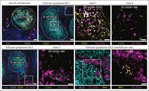 Location of DC-SIGN+ cells in the FL TME. Cell DIVE-IBEX images depicting location of cell types expressing DC-SIGN in non-FL and FL LNs and IRF4+BCL2+ tumor B cells in close proximity to DC-SIGN+ macrophages outside of the follicles. Scale bar, 50 μm (large images) and 25 μm (insets). Arrows show contact between DC-SIGN+ macrophages and IRF4+ cells. FDCs and DC-SIGN+ macrophages (MΦ). DC-SIGN+ macrophages defined by morphology and location in the LN.
