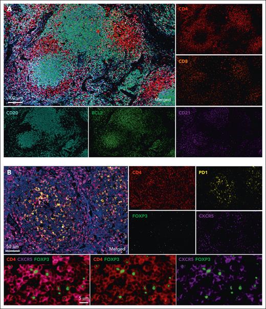 In situ phenotyping of FL grade 1/2 on formalin-fixed, paraffin-embedded sections using multiplex immunohistochemistry. (A) The normal architecture of the LN is effaced by neoplasia follicles of malignant B cells (CD20, clone L26, cyan) sustained by CD21+ FDCs (clone EP3093, magenta). Tumor cells strongly express BCL2 (clone SP66, green). Tumor-infiltrating T cells include a high number of CD4+ T cells (red) in interfollicular and intrafollicular areas, whereas CD8+ T cells (clone C8/144B, orange) are less numerous and usually observed at the follicle border. (B) Detection of Tfh and Tfr subpopulations in FL. Tfh cells are mostly observed in neoplastic follicles and coexpress CD4 (red), PD1 (clone NAT105, yellow), and CXCR5 (clone D6L3C, magenta). High magnification of follicle area shows Tfr positive for CD4 (red), CXCR5 (magenta), and FOXP3 (clone EP340, green).