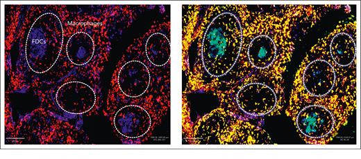 Expression of DC-SIGN in FL tissue. A representative case of FL is shown without (left) or with (right) staining with antiDC-SIGN by immunofluorescence. In the left panel, M2 macrophages, mainly in the interfollicular area, are stained red with anti-CD163, and FDCs in the neoplastic follicles outlined in dotted white lines are stained blue with anti-CD23. In the right panel, M2 macrophages costained with green anti-DC-SIGN appear yellow. FDCs costained with green anti-DC-SIGN appear cyan.