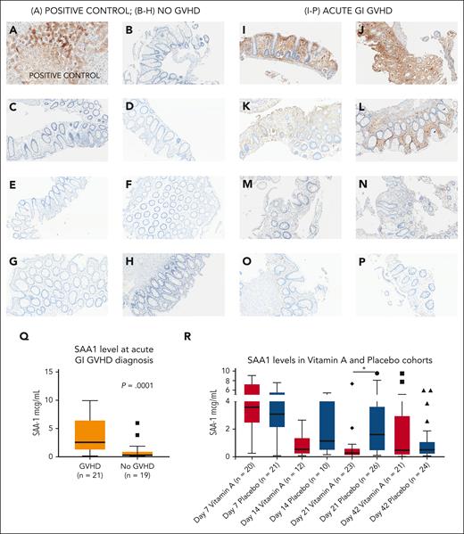 Serum amyloid A1 in acute GI GVHD and SAA1 levels in the vitamin A and placebo cohorts. (A) Liver (positive control); SAA1 is strongly expressed in hepatocytes as expected. (B-H) No GVHD: immunohistochemical stain for SAA1 in human colon tissue sections; no SAA1 staining observed. (I-P) Acute GI GVHD: immunohistochemical stain for SAA1 in human GVHD colonic tissue sections. (I-J) Strong SAA1 staining of intestinal epithelium and lamina propria. (K-L) Increased SAA1 superficial density and staining of crypts, lamina propria, and stroma. (M-N) Patchy epithelial SAA1 staining of lamina propria and intestinal epithelial cells. (O-P) Weak focal to patchy SAA1 staining of lamina propria. (Q) SAA1 levels in an independent cohort of 21 patients with acute GI GVHD at time of diagnosis (median day of onset of acute GI GVHD was day +42 after HSCT) and 19 recipients of allogeneic HSCT without acute GVHD at ∼day +42 after HSCT. (R) SAA1 levels at day +7, day +14, day +21, and day +42 after HSCT the vitamin A and placebo study arms. ∗P < .05.