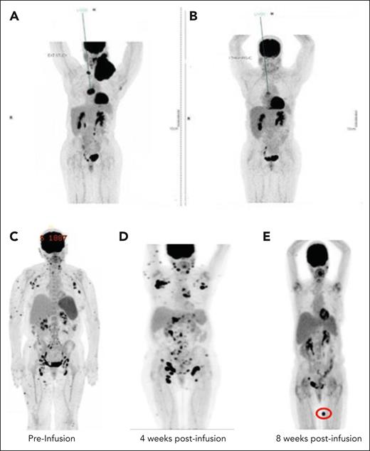 Kinetics of CAR T responses by PET-CT imaging. Preinfusion (A) PET-CT of patients with ATLL treated at DL2 and postinfusion (B) PET/CT 4 weeks after CD5 CAR T-cell administration. (C) Preinfusion PET/CT of a patient with AITL (no. 5); (D) PET/CT 4 weeks after infusion showing increased markedly hypermetabolic lymph nodes and increased uptake in subcutaneous nodules; (E) PET/CT 8 weeks after CD5 CAR T-cell administration showed resolution of nearly all of the previous hypermetabolic abnormalities and appearance of 1 new FDG-avid lesion (indicated by red oval).