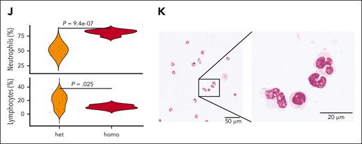 Molecular and clinical characteristics of patients with TN-PMF. (A-D) Representative BM seriated sections from 2 patients with TN-PMF, stained with H&E (A,C) and reticulin stain (B,D). Fibrosis with osteomyelosclerosis and megakaryocyte hyperplasia (with cluster formation and atypical forms) associated with fibrosis grade 3 are shown in panels A and B and in panels C and D, respectively. Bars: 500 μm in panels A and B, and 200 μm in panels C and D. (E) Oncoprint reporting the somatic mutations identified in the TN-PMF cohort. The orange and green bars highlight the patients with SETBP1-positive and -negative disease, respectively. (F) Kaplan-Meier survival analysis. Patients with TN-PMF were stratified according to the somatic mutational burden, with SETBP1-positive cases shown in orange and patients with SETBP1-negative disease shown in green. The log-rank test was used to test for differences in survival between the 2 groups. Tick marks indicate censored data. (G-I) Fish plots showing somatic evolution of the disease in 3 patients with TN-PMF. In 2 cases (G,I), a late acquisition of homozygous SETBP1 mutation is observed. (J) Neutrophil and lymphocyte populations in the PB from homozygous (homo) and heterozygous (het) SETBP1G870S mice. (K) H&E staining of the PB from a 30-day-old homozygous SETBP1G870S mouse showing accumulation of mature granulocytes.