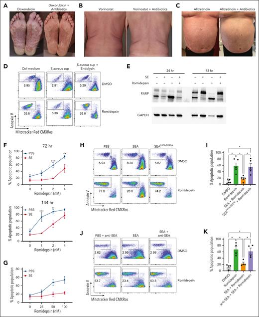 S aureus culture supernatants and SE induce drug resistance in malignant T cells. (A-C) Photographs of affected skin from 3 patients with SS before and after antibiotic treatment with ongoing cancer-directed treatments: (A) doxorubicin (SS1), (B) vorinostat (SS2), and (C) alitretinoin (SS3). (D) Flow cytometric plots showing apoptotic fraction of malignant T cells from SS17 PBMCs after 72 hours of treatment with 2 nM romidepsin and bacterial culture supernatant (sup) from S aureus cultured in the presence or absence of endolysin. The used S aureus strain was originally isolated from lesional skin of a different patient with SS. For control, tryptic soy broth medium (Ctrl medium) was added to the PBMC culture. (E) Western blot showing cleaved and uncleaved PARP expression after 24- and 48-hour treatment of SS4 PBMCs with either SE and/or romidepsin. GAPDH is used as a loading control. (F) Apoptotic fraction of malignant cells from PBMCs of 5 patients with SS (SS4, SS5, SS8, SS9, and SS12) after 72 and 144 hours treated with increasing concentrations of romidepsin in the presence (SE) or absence (PBS) of SE. Statistical significance was assessed by 2-way analysis of variance (ANOVA) followed by the Šídák multiple comparisons test. ∗∗P < .01; ∗∗∗P < .0005. (G) Apoptotic fraction of malignant cells from PBMCs of 2 patients with SS (SS8 and SS12) after a different 6 hours pulse, 16 hours chase in vitro treatment regimen with high concentrations of romidepsin in the presence (SE) or absence (PBS) of SE. (H-I) Representative flow cytometric plots (H; SS13) and quantification (I) of apoptotic fraction of malignant cells from PBMCs of 5 patients with SS (SS4, SS8, SS12, SS13, and SS15) after 72 hours of treatment with 2 nM romidepsin in presence of wild-type SEA or mutant SEA (SEAF47A/D227A). (J-K) Representative flow cytometric plots (J; SS15) and quantification (K) of apoptotic fraction of malignant cells from 4 patients with SS (SS4, SS12, SS13, and SS15) after 72 hours of treatment with 2 nM romidepsin in presence of SEA or SEA and a blocking anti-SEA antibody. For panels I-K, statistical significance was assessed by repeated measures 1-way ANOVA followed by Tukey multiple comparison test. ∗P < .05. Ctrl, control; DMSO, dimethyl sulfoxide; GAPDH, glyceraldehyde-3-phosphate dehydrogenase.