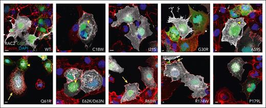 Effects of RAC2 mutations on cellular localization and morphology. COS-7 cells cotransfected with GFP (green) and various RAC2 mutants were stained for F-actin (red) and RAC2 (white), nuclei were counterstained with 4′,6-diamidino-2-phenylindole (blue). Representative merged images are shown. Scale bar, 10 μm. Yellow arrows, PM ruffling; yellow arrowheads, macropinosomes.