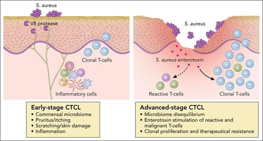 The deleterious effects of S aureus in CTCLs. Professional illustration by Patrick Lane, ScEYEnce Studios.