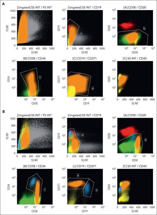 mm-SW in CD371pos BCP-ALL by flow cytometry. With the beginning of steroid treatment as per AIEOP-BFM ALL 2009 protocol, residual lymphoblastic cells showed an mm-SW. It displayed 2 different patterns: (A) a single population of blast cells with heterogeneous expression of CD19 (1-population pattern: orange population); and (B) a 2-population pattern: the first population keeping the immunophenotype of the diagnosis (blue population); the second population showing a downregulation of CD19 and CD34, an upregulation of CD45, and an increase of SSC (orange population). Technical information: fluorochromes: CD19-PC7, CD10-APC/ALEXA700, CD20- V450, CD34-APC, CD58-FITC, CD371-PC5.5, and CD45-V500; sample preparation and acquisition at ambient temperature; sample acquisition: Navios Flow Cytometer (Beckman Coulter, Inc); sample analysis: Software Kaluza 2.1 (Beckman Coulter, Inc). Please see supplemental Data for additional information.
