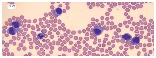 CD371pos BCP-ALL: standard morphology evaluation of a PB sample on day 8 of induction therapy. Standard morphology of a CD371pos BCP-ALL PB sample collected on day 8 of induction therapy revealed a population of monocytes at different maturation stages. Technical information: sample preparation and acquisition at ambient temperature; cytochemical staining: May-Grünwald-Giemsa; microscope model: Leica DM2000 LED (Leica Microsystem Srl, Buccinasco, Milan, Italy); objective: Leica HC PL Fluotar 40× objective (Leica Microsystem Srl); camera model: Leica DMC4500 (Leica Microsystem Srl); picture acquisition software: LAS (Leica Application Suite) version 4.13 (Leica Microsystem Srl).