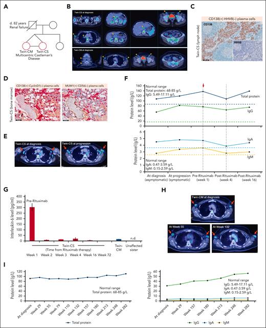 Disease characteristics of affected twins with iMCD. (A) Pedigree chart of affected twins with iMCD (red circles). (B) Representative 18-FDG PET/CT images in the affected twins. Twin-CS: enlarged, hypermetabolic lymph nodes in the neck, axilla, chest, abdomen and pelvis, as well as diffuse increased FDG uptake in the bone marrow and spleen. Twin-CM: enlarged, hypermetabolic lymph nodes in the neck, axilla, and pelvis, as well as diffuse increased FDG uptake in the bone marrow. Orange arrows: enlarged lymph nodes (short axis diameter ≥1 cm). Asterisk: bone marrow involvement. (C) Medullary and interfollicular CD138+/HHV8− plasma cells in the lymph node from Twin-CS (scale bar, 500 μm). (D) Dual immunohistochemistry for CD138 (red)-cyclin D1 (brown) and MUM1 (red)-CD56 (brown) showing that mature plasma cells in the bone marrow are CD138+/cyclin D1− and MUM1+/CD56−. Physiological expression of cyclin D1 can be observed in scattered histiocytic nuclei and expression of CD56 is seen in osteoblastic rims surrounding a bony trabeculae (scale bar, 100 μm). (E) 18-FDG PET/CT showing hypermetabolic enlargement and metabolic progression of axillary nodal disease (red arrows, axillary nodes) 42 months from diagnosis for Twin-CS (SUVmax, 3.9-5.4; short axis diameter, 1.5-1.7 cm). (F) Increasing serum total protein levels along with disease progression. A transient decline in immunoglobulin levels was observed after 4 doses of rituximab therapy. Dotted lines represent upper limit of normal ranges of protein levels. Red arrow indicates start of rituximab therapy. (G) Rapid and sustained decline of IL-6 levels after rituximab treatment in Twin-CS (week 1, 303.3 pg/mL; week 2, 10.2 pg/mL; week 16, 6.7 pg/mL; week 72, 0.7 pg/mL). As comparison, IL-6 level of affected but asymptomatic Twin-CM was 16.9 pg/mL and was not detectable (n.d.) in the unaffected sister. Results are represented by mean values and standard deviations (error bars). Panels B and C are illustrated again in supplemental Figure 1. (H) 18-FDG PET/CT showed hypermetabolic bilateral axillary lymph nodes demonstrating interval stability (red arrows) for Twin-CM. (I) Trend of serum total protein, IgG, IgA, and IgM levels from diagnosis and follow-up for Twin-CM. IgG, immunoglobulin G; SUVmax, maximum standardized uptake value.